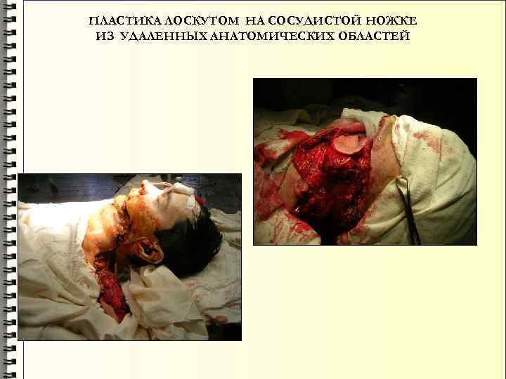 ПЛАСТИКА ЛОСКУТОМ НА СОСУДИСТОЙ НОЖКЕ ИЗ УДАЛЕННЫХ АНАТОМИЧЕСКИХ ОБЛАСТЕЙ 