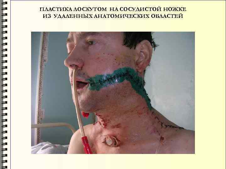 ПЛАСТИКА ЛОСКУТОМ НА СОСУДИСТОЙ НОЖКЕ ИЗ УДАЛЕННЫХ АНАТОМИЧЕСКИХ ОБЛАСТЕЙ 