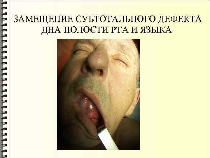 ЗАМЕЩЕНИЕ СУБТОТАЛЬНОГО ДЕФЕКТА ДНА ПОЛОСТИ РТА И ЯЗЫКА 