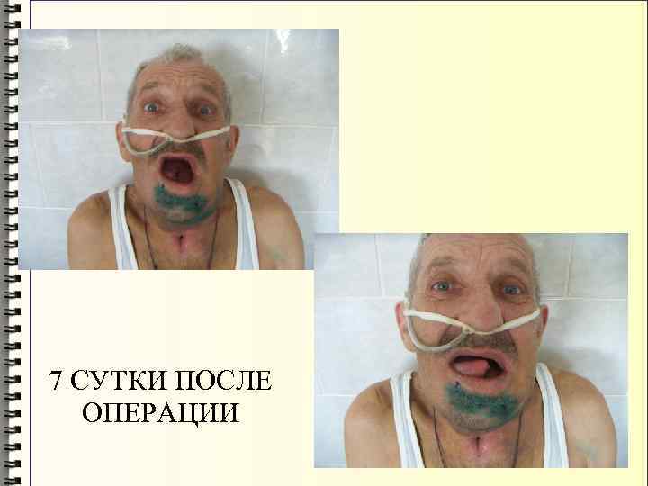 7 СУТКИ ПОСЛЕ ОПЕРАЦИИ 