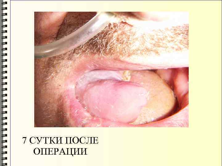 7 СУТКИ ПОСЛЕ ОПЕРАЦИИ 