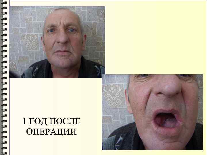 1 ГОД ПОСЛЕ ОПЕРАЦИИ 