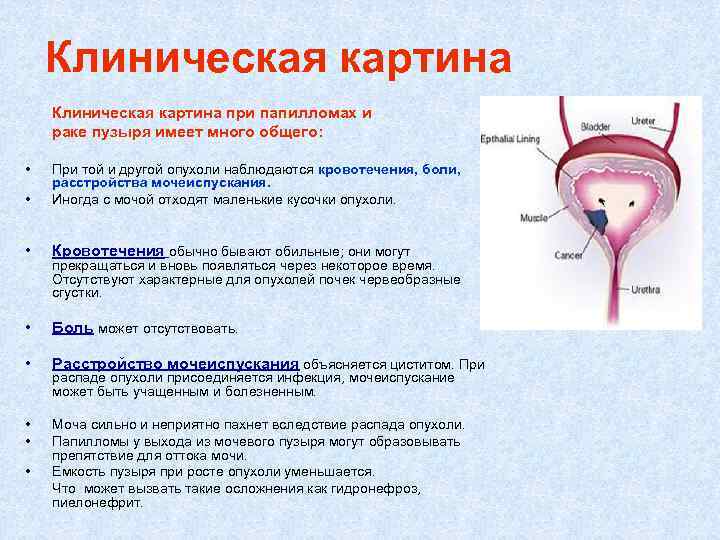 Клиническая картина при папилломах и раке пузыря имеет много общего: • • При той