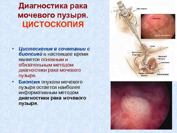 Диагностика рака мочевого пузыря. ЦИСТОСКОПИЯ • Цистоскопия в сочетании с биопсией в настоящее время