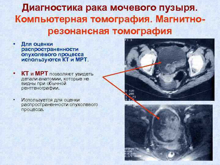 Диагностика рака мочевого пузыря. Компьютерная томография. Магнитнорезонансная томография • Для оценки распространенности опухолевого процесса