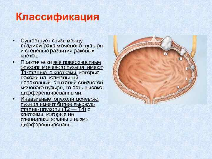 Классификация • • • Существует связь между стадией рака мочевого пузыря и степенью развития