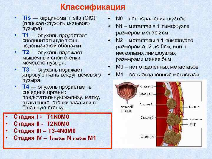 Классификация • Тis — карцинома in situ (CIS) • • (плоская опухоль мочевого пузыря)