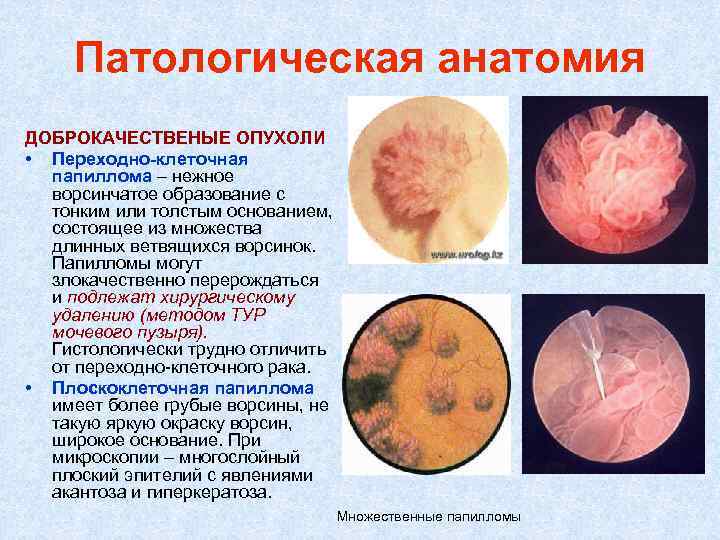 Опухоли патологическая анатомия презентация