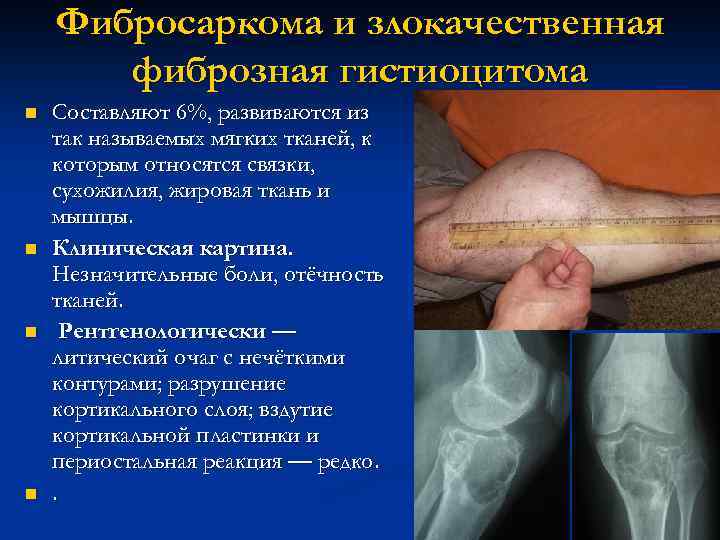 Фибросаркома и злокачественная фиброзная гистиоцитома n n Составляют 6%, развиваются из так называемых мягких