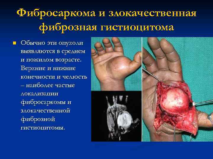 Фибросаркома и злокачественная фиброзная гистиоцитома n Обычно эти опухоли выявляются в среднем и пожилом