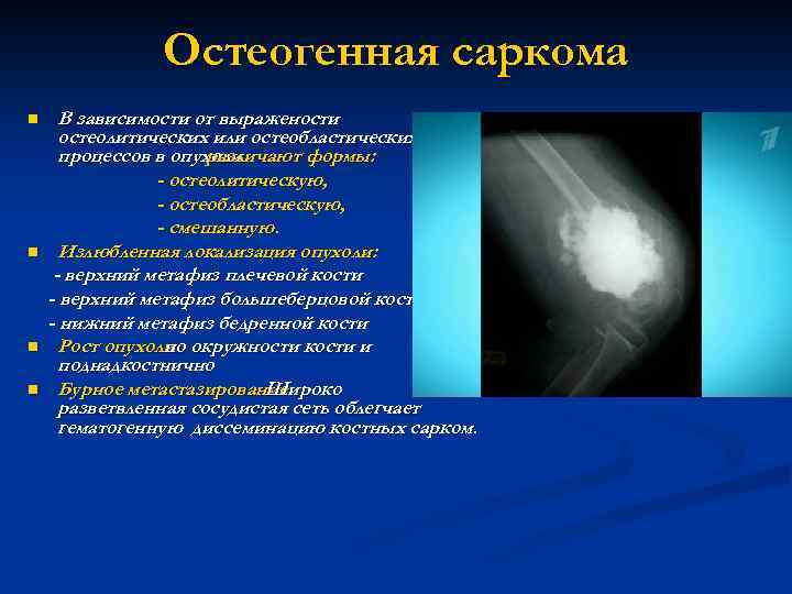 Виды сарком. Остеогенная саркома остеобластическая форма. Остеогенная саркома патогенез. Остеогенную саркому (костная ткань). Остеогенная саркома локализация.