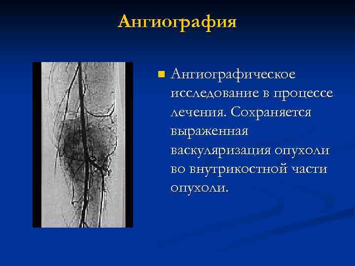 Опухоли костей и мягких тканей презентация