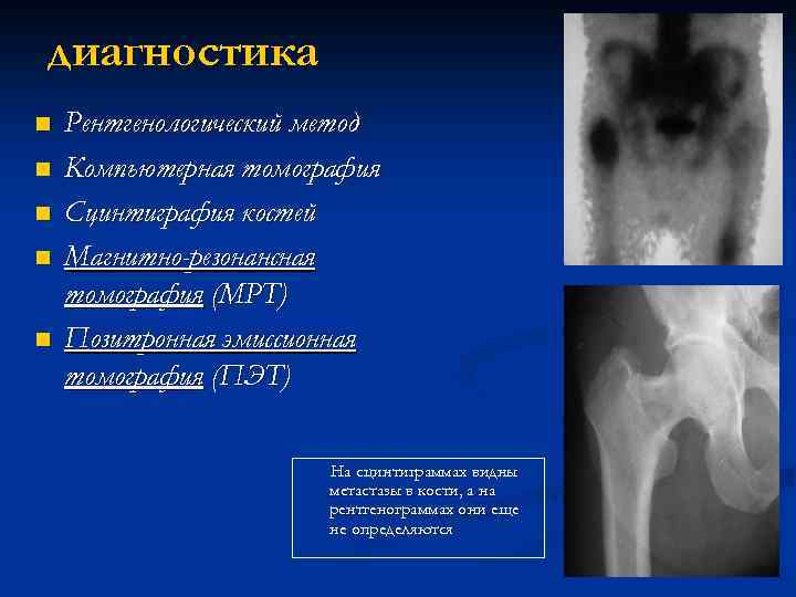 Рак костей анализы