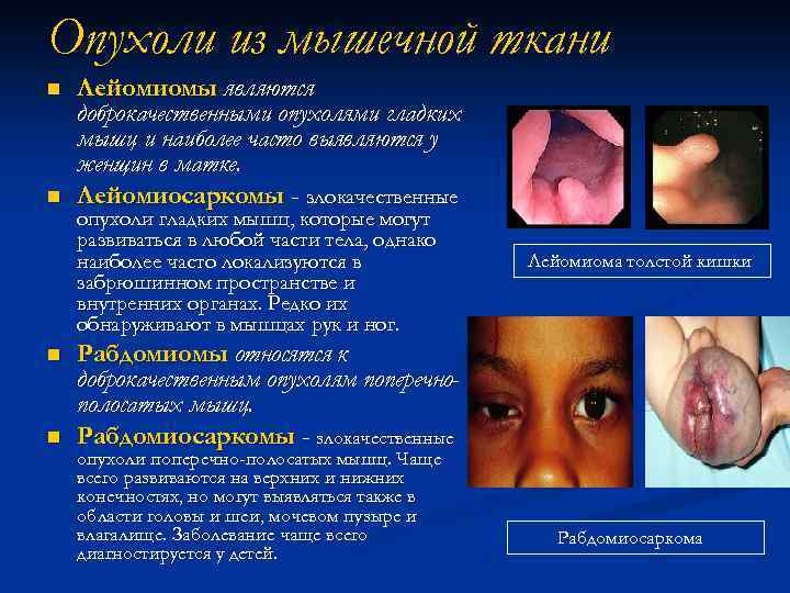 Опухоли из мышечной ткани n n Лейомиомы являются доброкачественными опухолями гладких мышц и наиболее