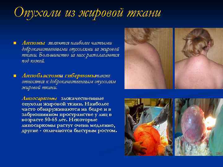Опухоли из жировой ткани n Липомы являются наиболее частыми n Липобластомы гиберномытакже и доброкачественными