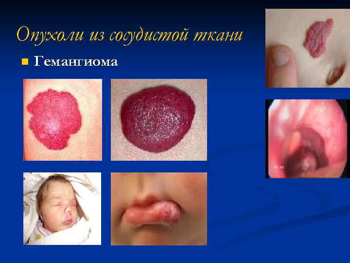Опухоли из сосудистой ткани n Гемангиома 