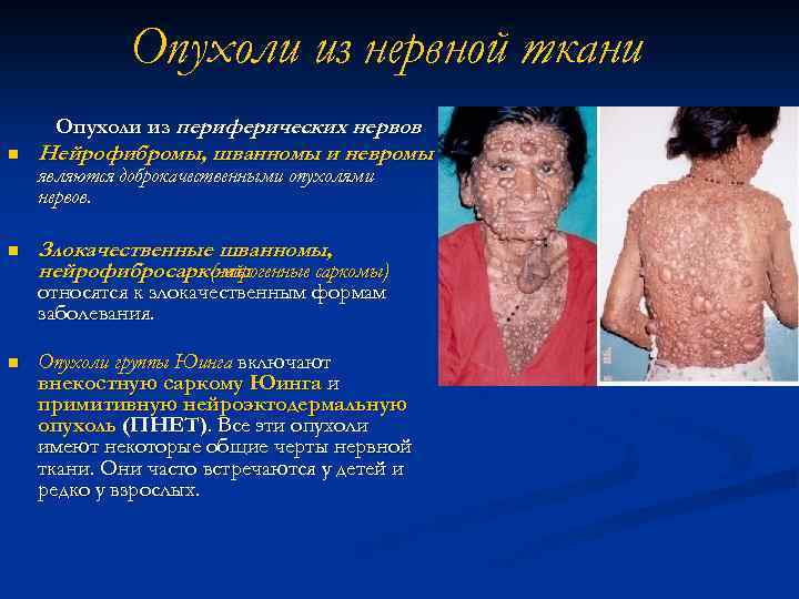 Опухоли из нервной ткани Опухоли из периферических нервов n Нейрофибромы, шванномы и невромы n