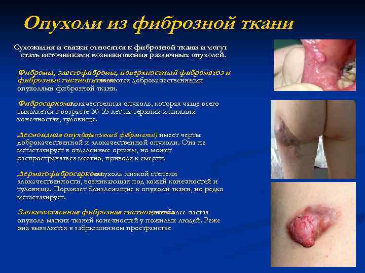 Опухоли из фиброзной ткани Сухожилия и связки относятся к фиброзной ткани и могут стать