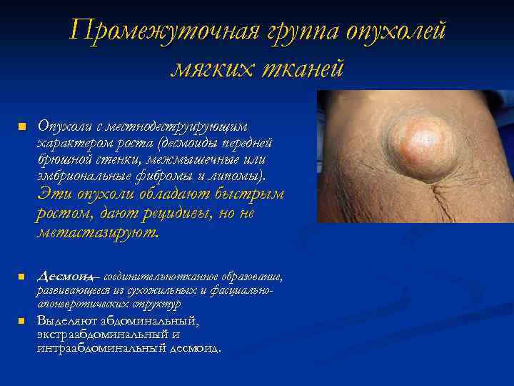 Промежуточная группа опухолей мягких тканей n Опухоли с местнодеструирующим характером роста (десмоиды передней брюшной