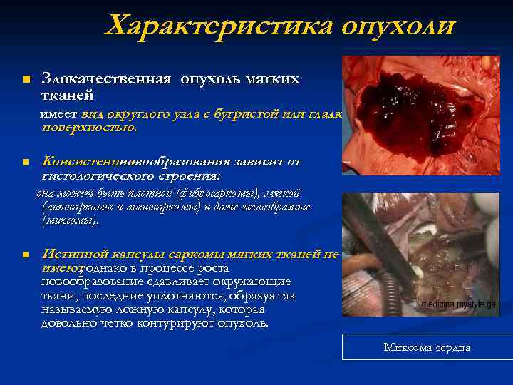 Характеристика опухоли n Злокачественная опухоль мягких тканей имеет вид округлого узла с бугристой или