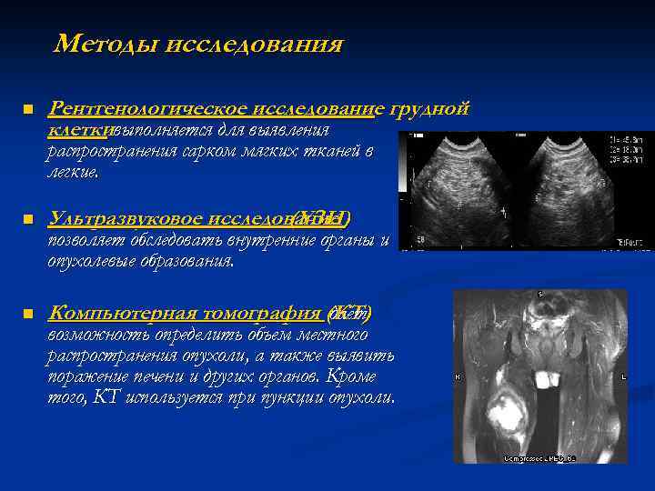Методы исследования n Рентгенологическое исследование грудной клеткивыполняется для выявления распространения сарком мягких тканей в