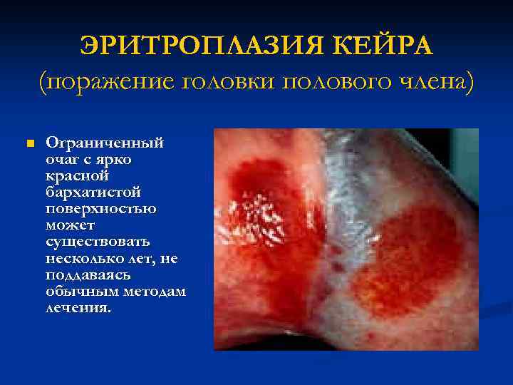 ЭРИТРОПЛАЗИЯ КЕЙРА (поражение головки полового члена) n Ограниченный очаг с ярко красной бархатистой поверхностью