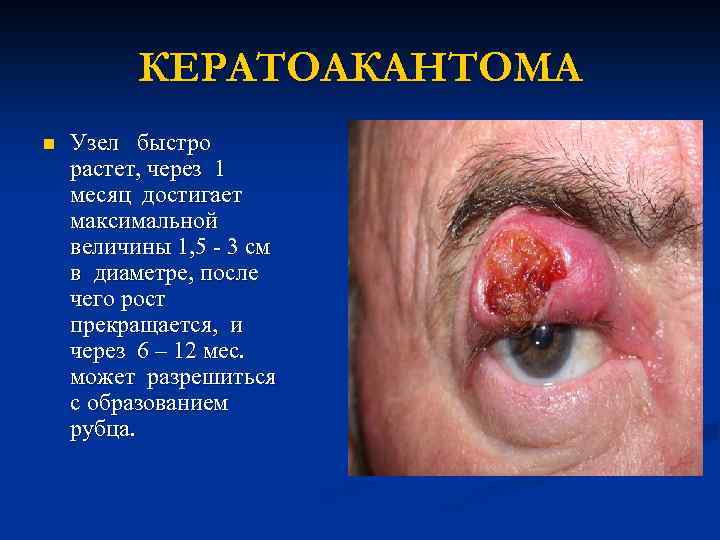 КЕРАТОАКАНТОМА n Узел быстро растет, через 1 месяц достигает максимальной величины 1, 5 -