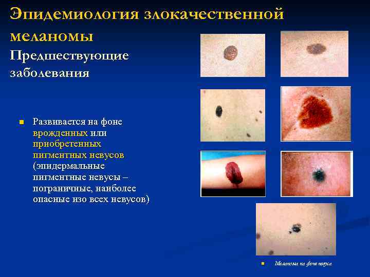 Эпидемиология злокачественной меланомы Предшествующие заболевания n Развивается на фоне врожденных или приобретенных пигментных невусов