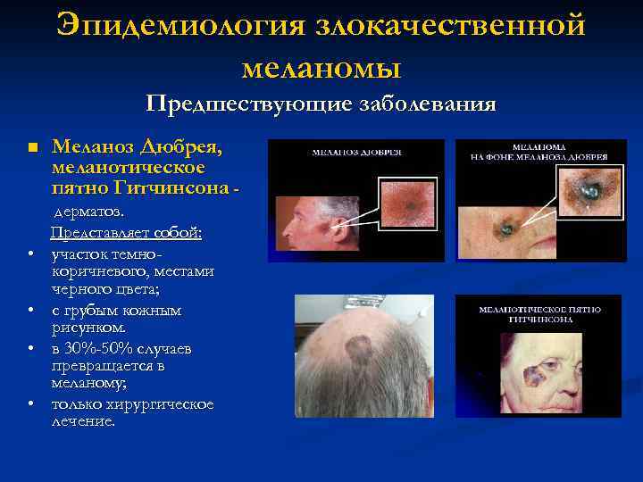 Эпидемиология злокачественной меланомы Предшествующие заболевания n • • Меланоз Дюбрея, меланотическое пятно Гитчинсона дерматоз.