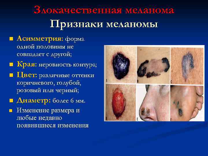 Злокачественная меланома Признаки меланомы n Асимметрия: форма одной половины не совпадает с другой; n