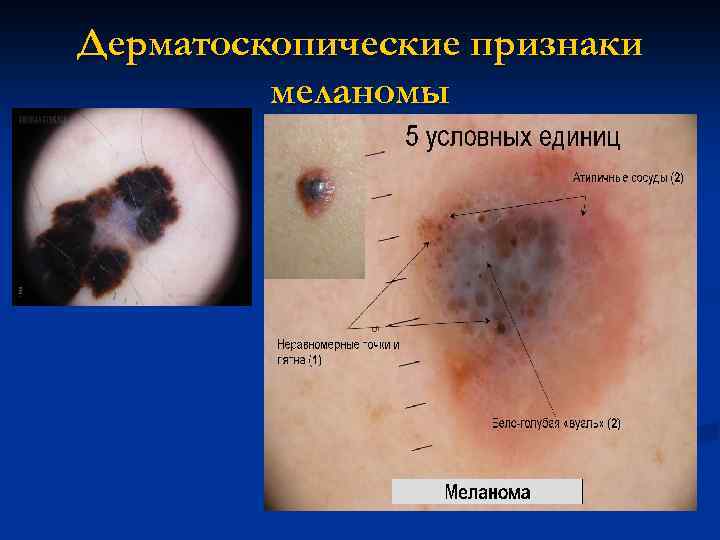 Дерматоскопические признаки меланомы 