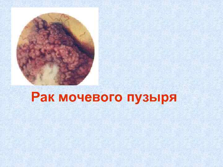 Рак мочевого пузыря 