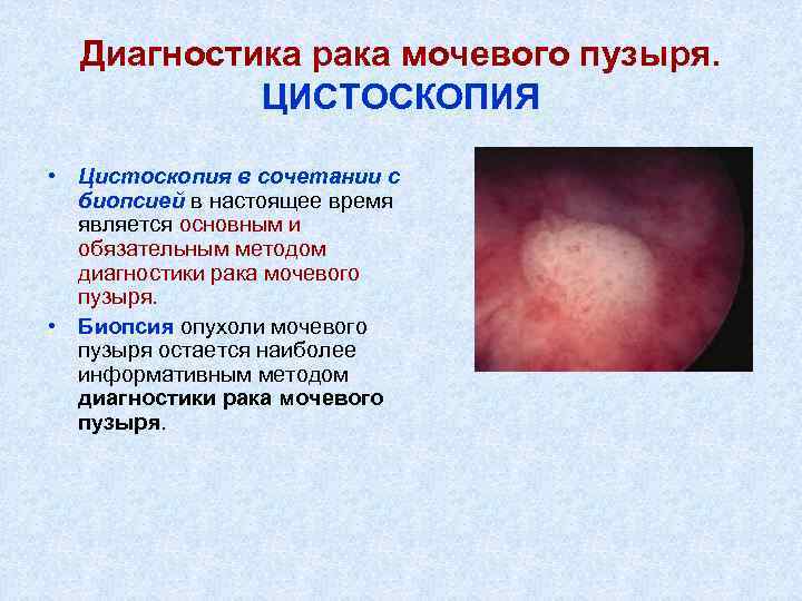 Диагностика рака мочевого пузыря. ЦИСТОСКОПИЯ • Цистоскопия в сочетании с биопсией в настоящее время