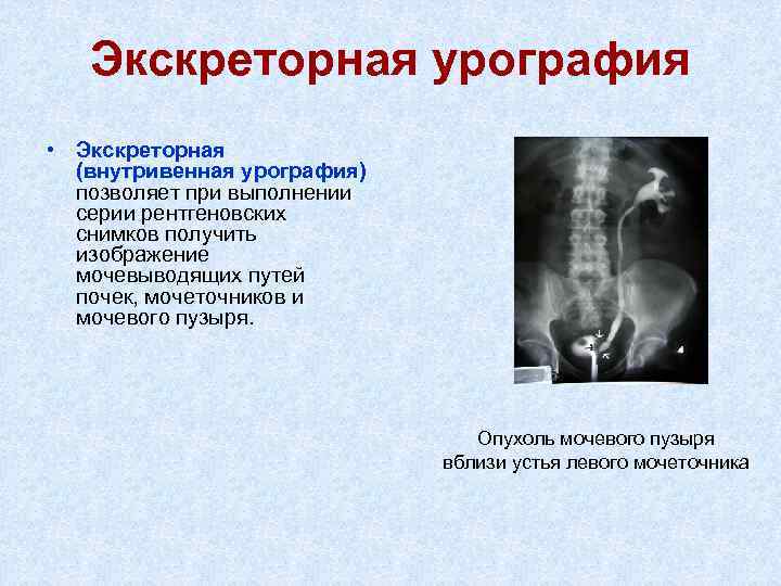 Экскреторная урография • Экскреторная (внутривенная урография) позволяет при выполнении серии рентгеновских снимков получить изображение