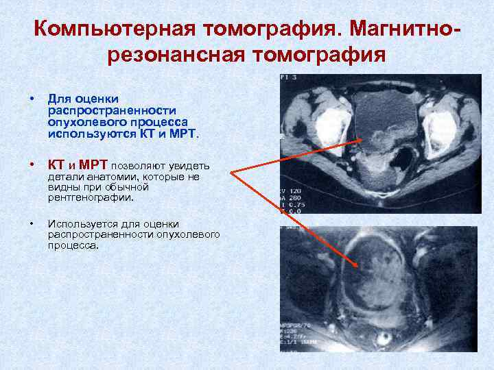 Компьютерная томография. Магнитнорезонансная томография • Для оценки распространенности опухолевого процесса используются КТ и МРТ.