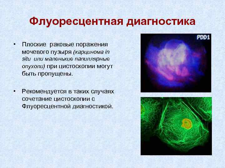 Рак мочевого пузыря презентация