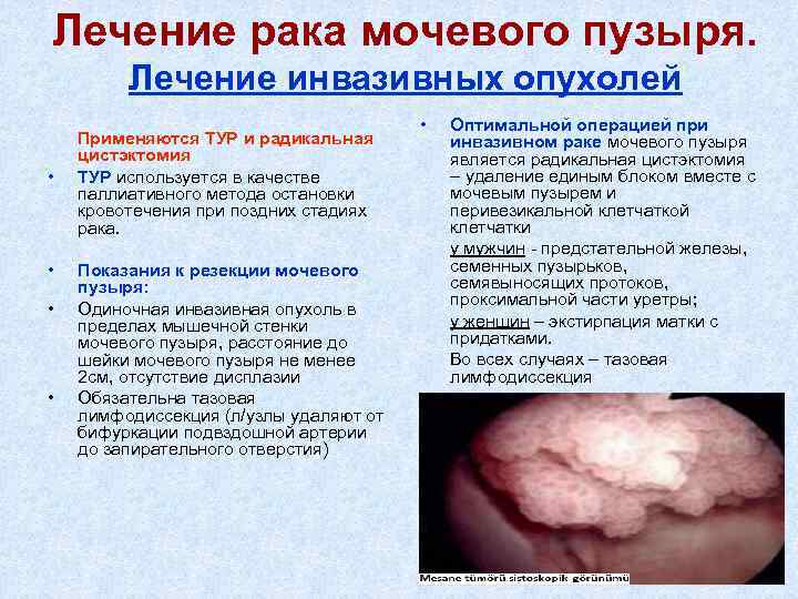 Лечение рака мочевого пузыря. Лечение инвазивных опухолей Применяются ТУР и радикальная цистэктомия • ТУР