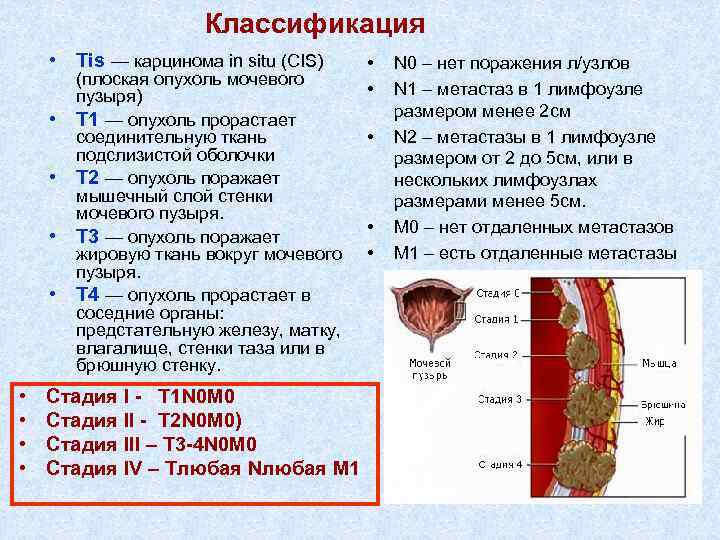 Классификация • Тis — карцинома in situ (CIS) • • (плоская опухоль мочевого пузыря)