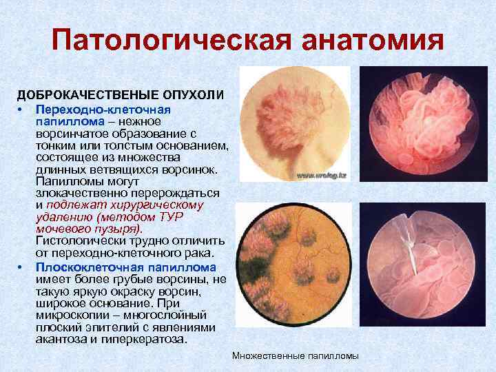 Патологическая анатомия ДОБРОКАЧЕСТВЕНЫЕ ОПУХОЛИ • Переходно-клеточная папиллома – нежное ворсинчатое образование с тонким или