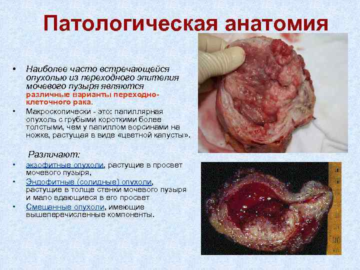 Патологическая анатомия • • Наиболее часто встречающейся опухолью из переходного эпителия мочевого пузыря являются