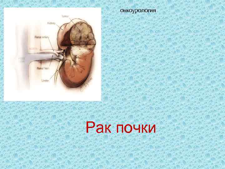 онкоурология Рак почки 