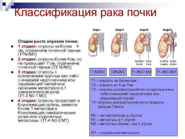 Стадии рака фото