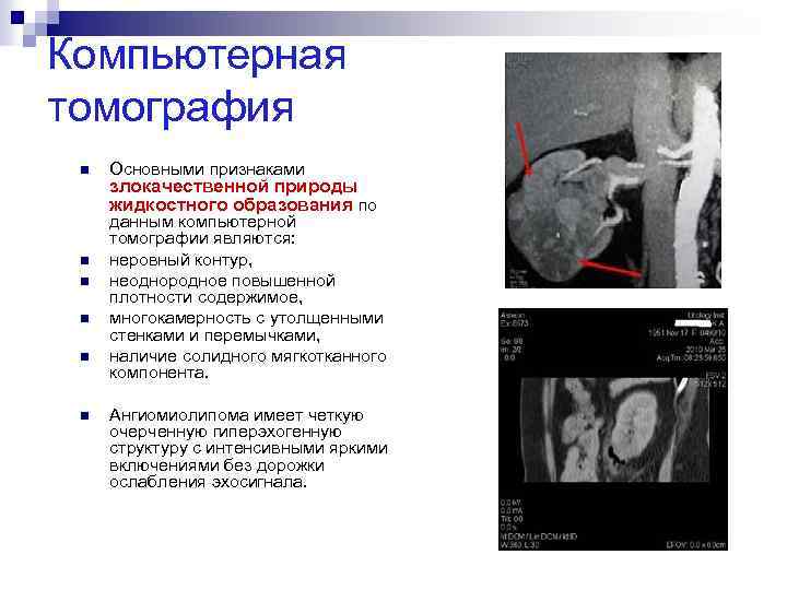 Компьютерная томография n n n Основными признаками злокачественной природы жидкостного образования по данным компьютерной