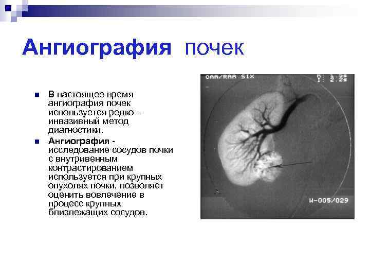 Ангиография почек n n В настоящее время ангиография почек используется редко – инвазивный метод