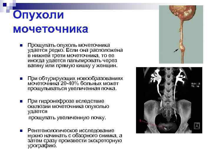 Камень в нижней трети мочеточника фото где расположен