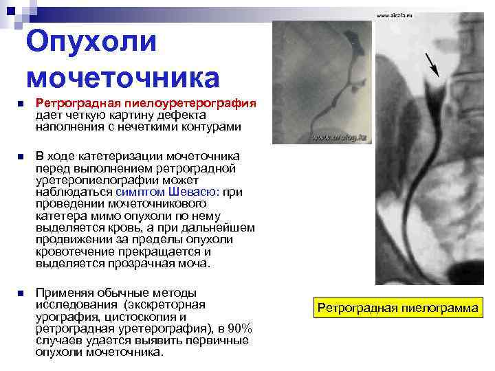 Опухоли мочеточника n Ретроградная пиелоуретерография дает четкую картину дефекта наполнения с нечеткими контурами n