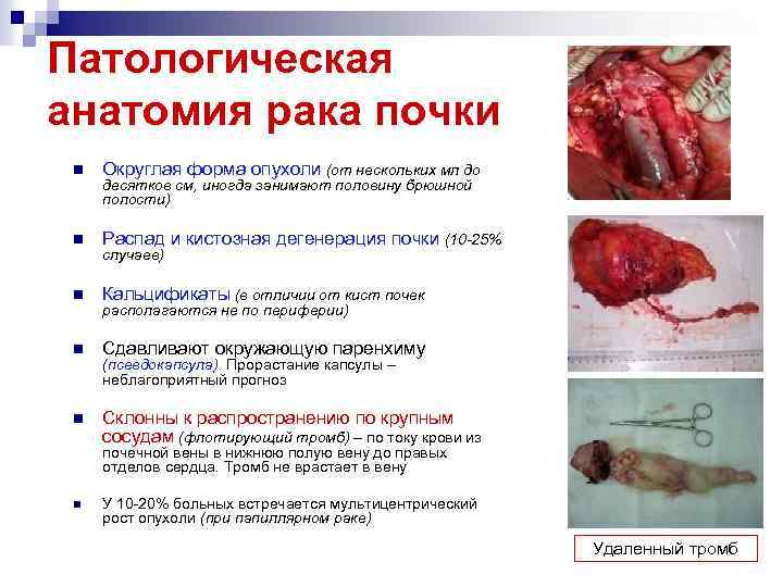 Патологическая анатомия рака почки n Округлая форма опухоли (от нескольких мл до n Распад