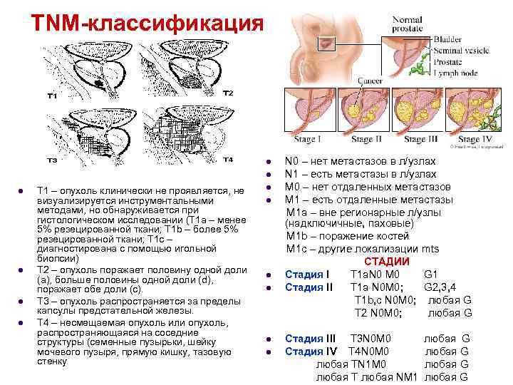 TNM-классификация l l l Т 1 – опухоль клинически не проявляется, не визуализируется инструментальными