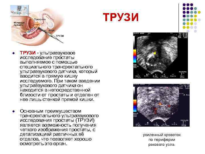 ТРУЗИ l ТРУЗИ - ультразвуковое исследование простаты выполняемое с помощью специального трансректального ультразвукового датчика,