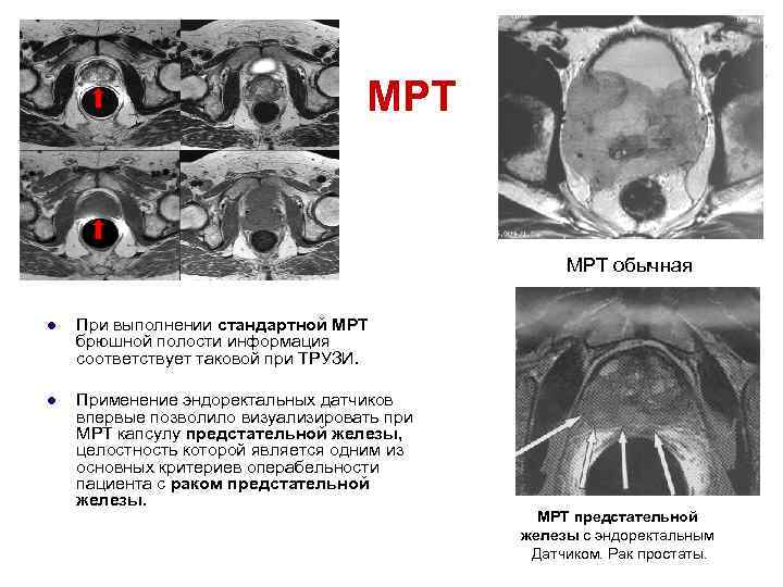 МРТ обычная l При выполнении стандартной МРТ брюшной полости информация соответствует таковой при ТРУЗИ.